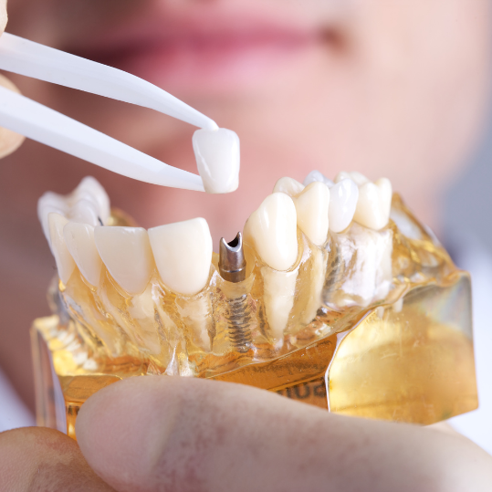 Dental Implants | Best Dental Implants in RR Nagar | Pragathi Dental Care