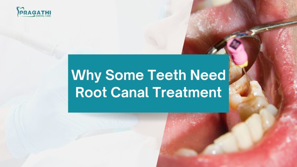 Root Canal Treatment in Bangalore | Dr. Beena Thomas