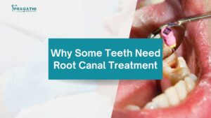 Root Canal Treatment in Bangalore | Dr. Beena Thomas